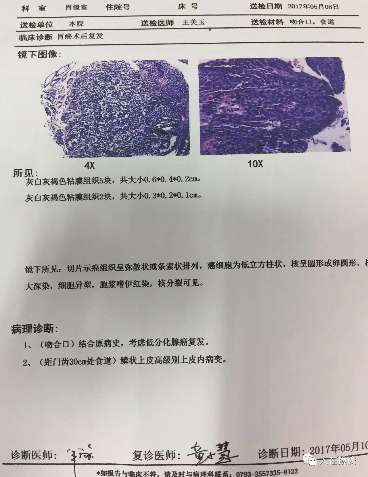 活检病理报告示食道鳞状上皮高级别上皮内瘤变.