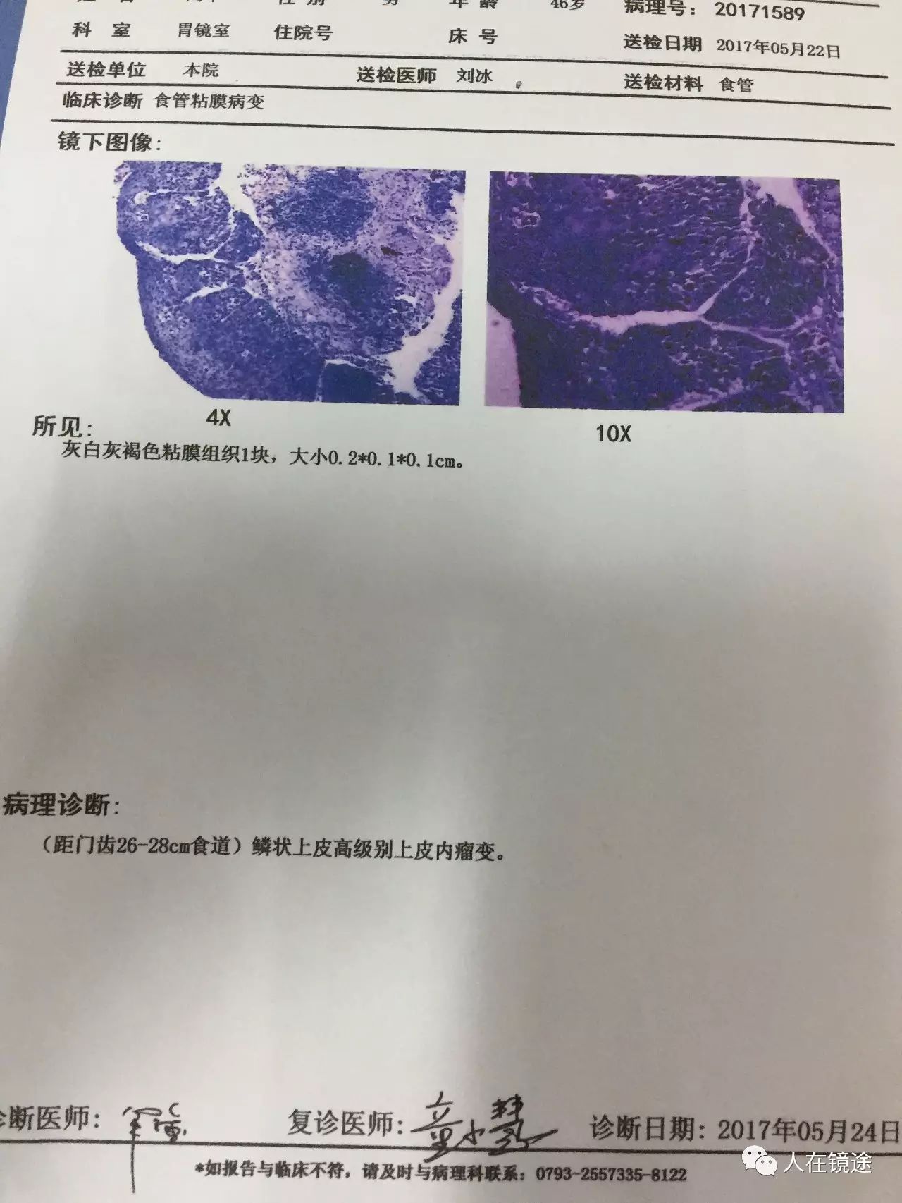 活检病理报告示鳞状上皮高级别上皮内瘤变.