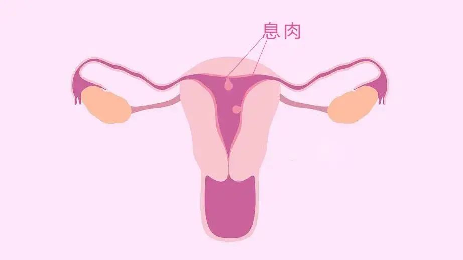 体检发现子宫内膜息肉该怎么办?