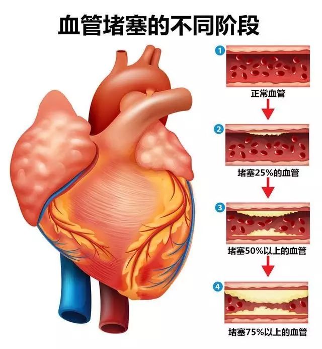 为什么年龄越大,血管就越容易老化,堵塞 年龄越大,血管越窄,杂质越多