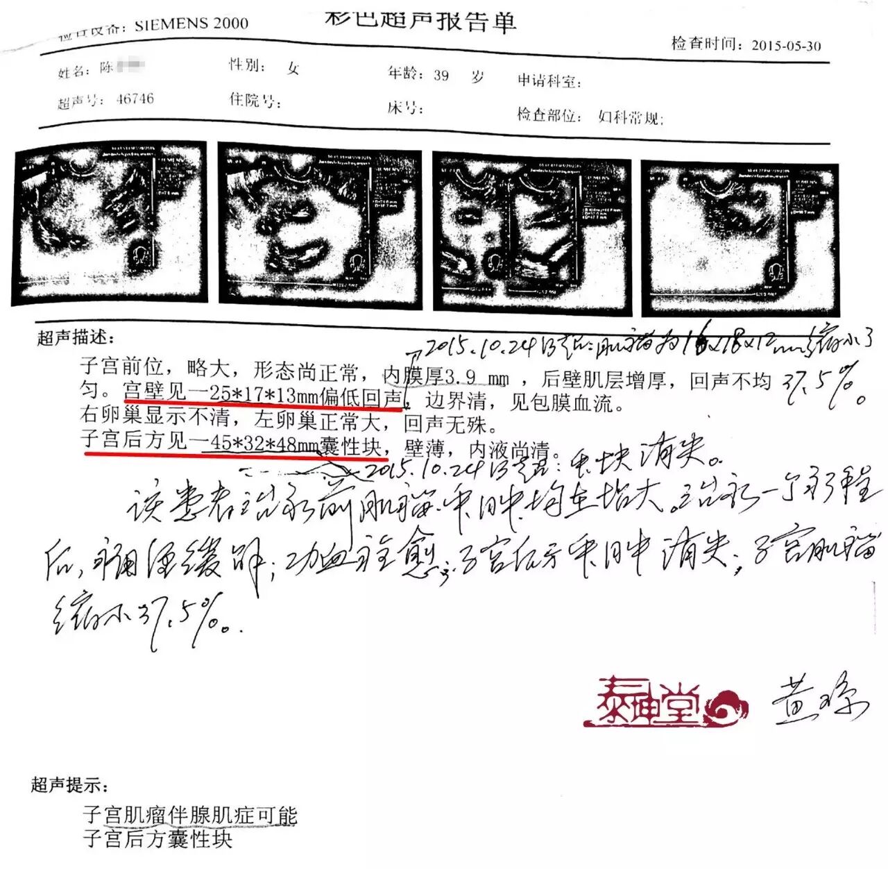 肌瘤囊肿伴肌腺症患者为二胎坚持不手术 治疗仅1个疗程 肌瘤缩小 卵巢囊肿消失 痛经缓解-怀孕期