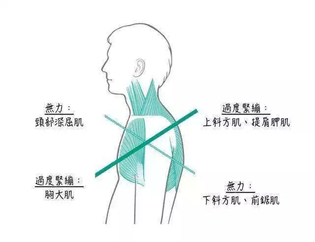 对应着斜方肌中下束,菱形肌,前锯肌及颈深屈肌群肌力不足所导致的一种