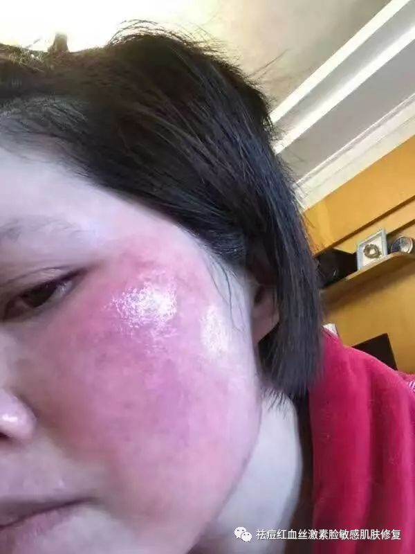 引起激素依赖性皮炎发烫的主要原因是,肌肤是有调节皮肤温度,代谢热量