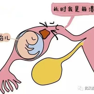 安以轩疑似宫外孕开刀保命,哪种女人更受宫外孕“青睐”