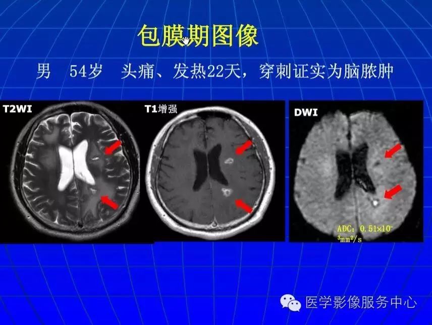 脑脓肿dwi动态变化