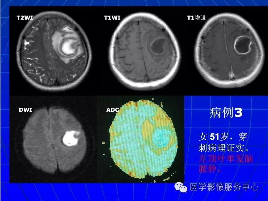 脑脓肿dwi动态变化