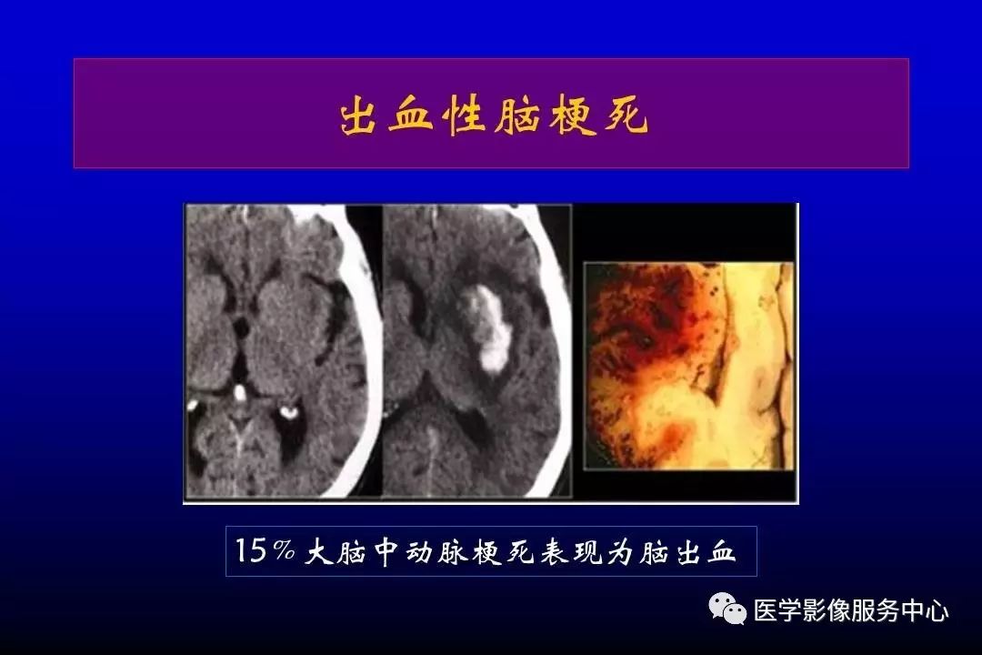 【必须推荐】急性脑梗死的影像学表现