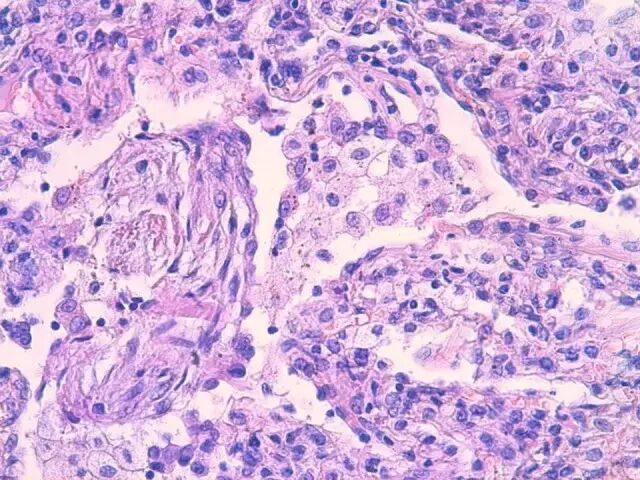 “炎性假瘤”？ OUT啦！