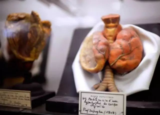 馆内收藏中还包括生殖器畸形或者坏死器官的标本,各种连体胚胎标本