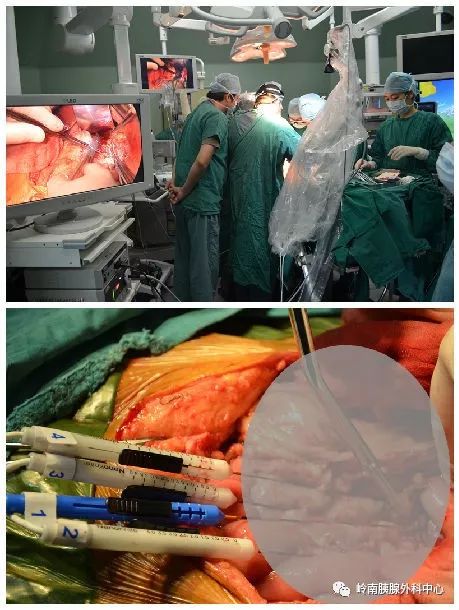 纳米刀联合化疗综合治疗晚期胰腺癌1例--本胰腺中心晚期不可切除胰腺