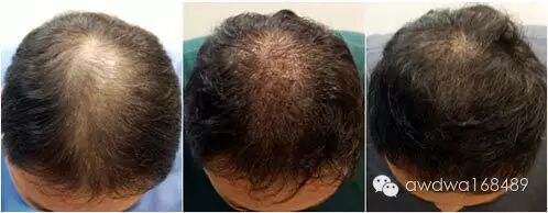 【圆满人生头发专家】快速有效的生发！花1分钟看完，让脱掉的头发茁壮成长！