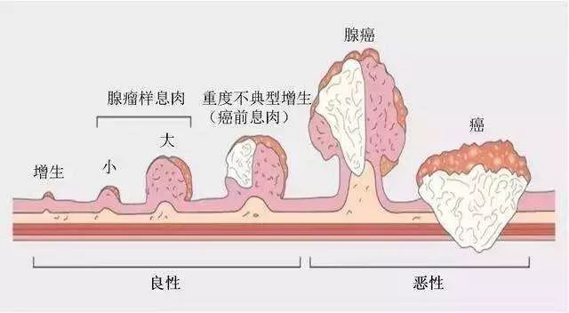 肠道息肉一颗肠道内的定时炸弹