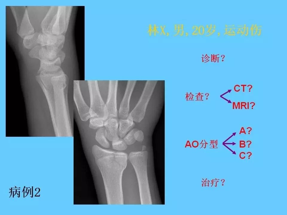 初步的腕部力学传导理论: 桡侧柱: 提供稳定性 –桡侧的骨性支持 –具