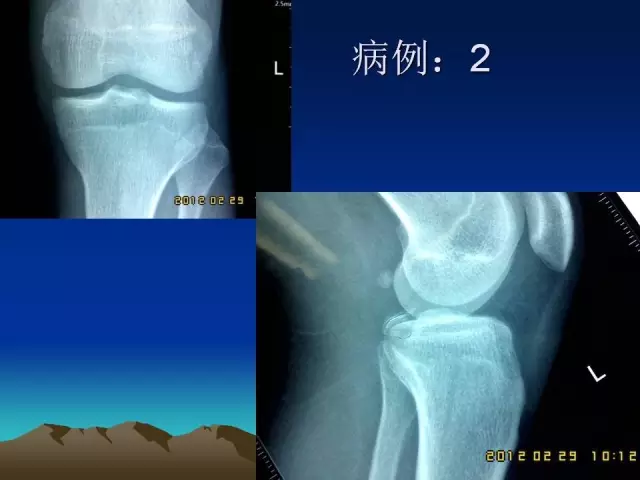 膝后内侧直切口入路治疗后交叉韧带