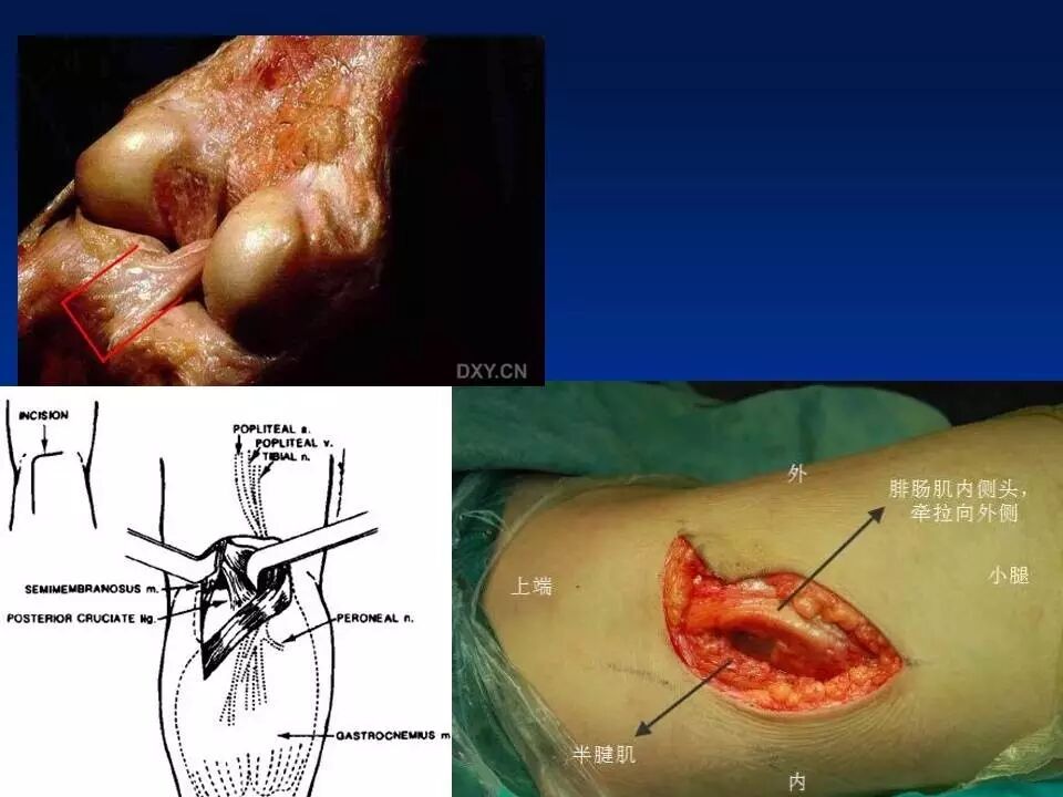 膝后内侧直切口入路治疗后交叉韧带