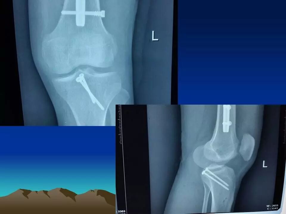 膝后内侧直切口入路治疗后交叉韧带