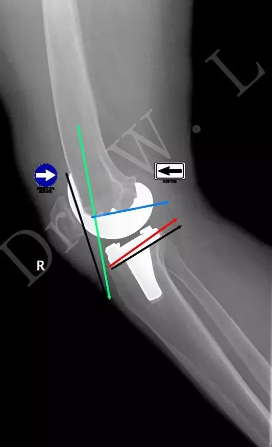 髌骨轴位观察,髌骨是否位于股骨假体滑车之中,可以判断髌骨轨迹的好坏