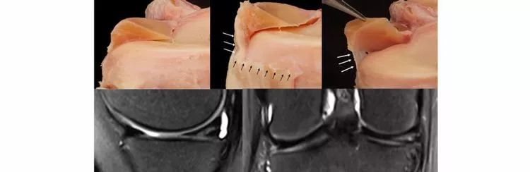 半月板一文轻松看懂半月板的解剖与临床