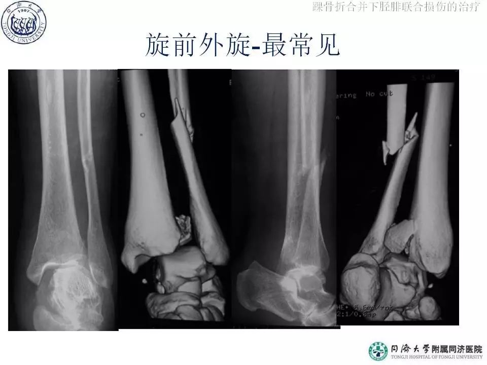 踝关节内侧结构损伤(骨折,三角韧带) 下胫腓联合失去完整性: 骨间膜