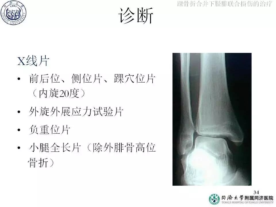 俞光荣:踝骨折合并下胫腓联合损伤的治疗(上)
