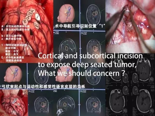[专访]天医总院杨学军: <wbr>率先应用经颅磁刺激技术 <wbr>胶质母细胞瘤影像学全切除率95%以上 <wbr>科