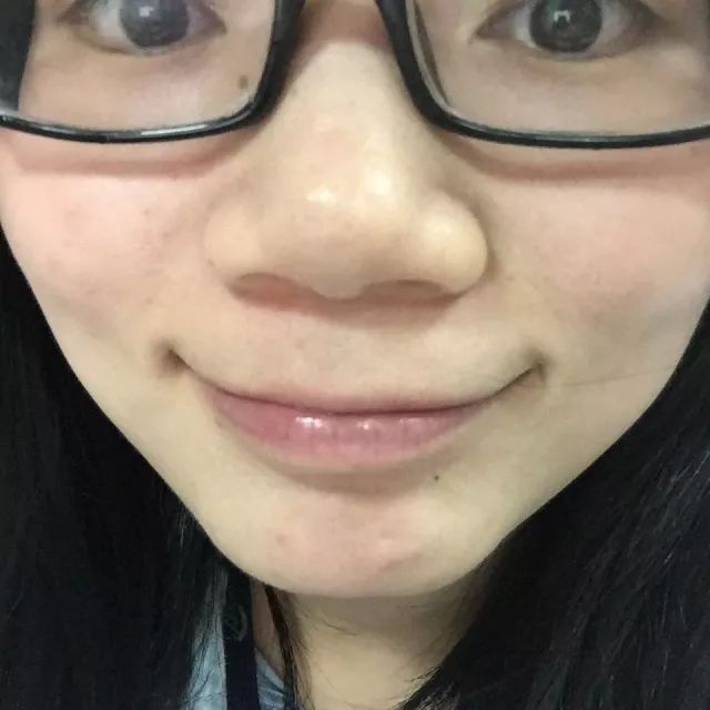 痘印的解决方法_痘印心得经验_痘印的烦恼