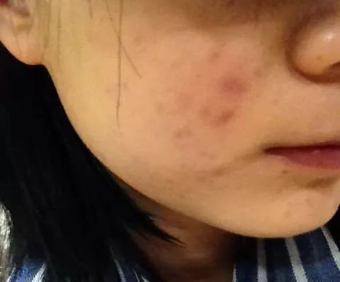 痘印的烦恼_痘印的解决方法_痘印心得经验
