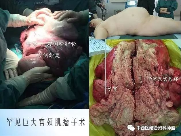 经外阴阴道手术:外阴阴道癌手术,处女膜修补及阴道修补,阴式子宫肌瘤