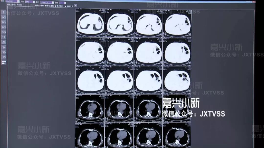 【嘉兴人去医院看病可以省这笔钱】胶片不用打印 有些