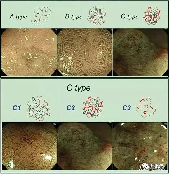 结直肠癌的前身腺瘤性肠息肉