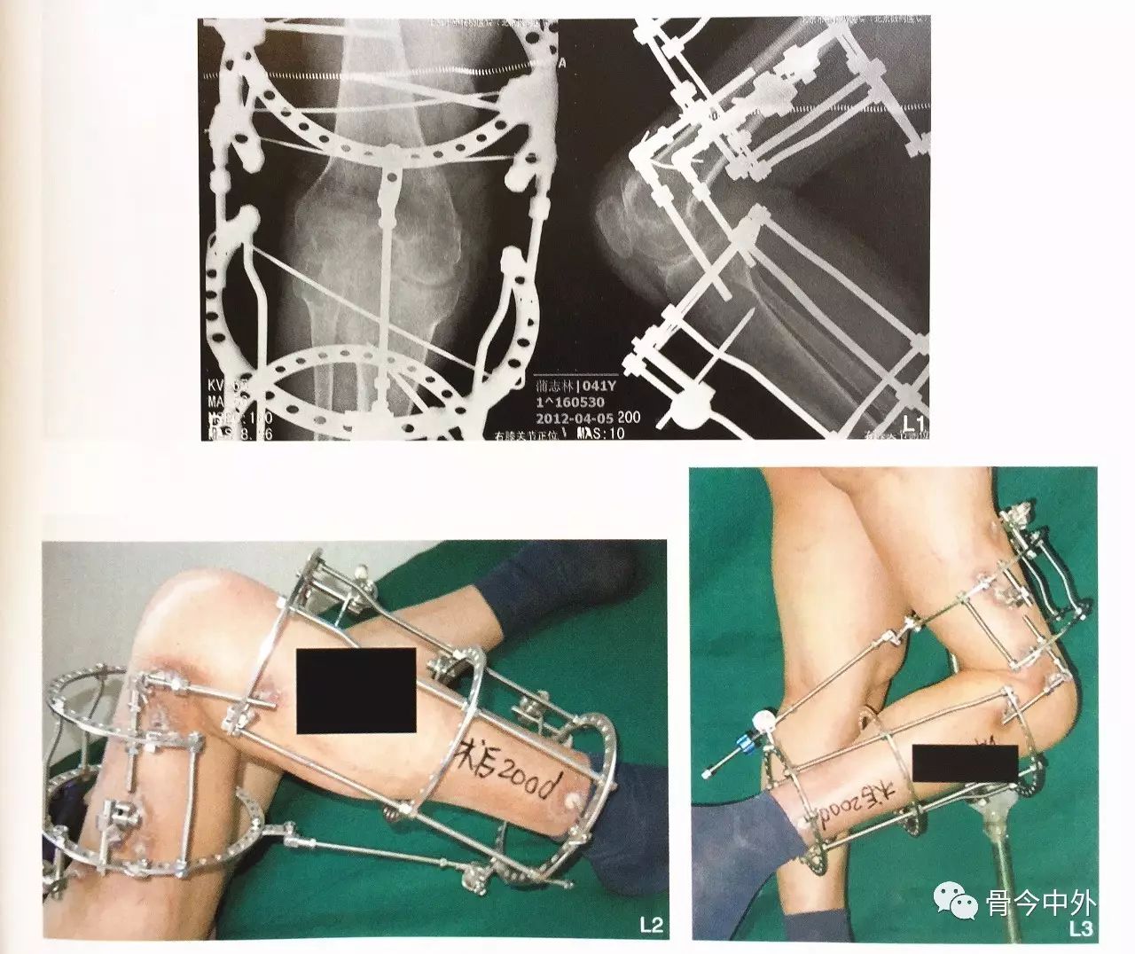 ilizarov膝关节牵伸器:膝关节僵直与复合畸形的外固定治疗