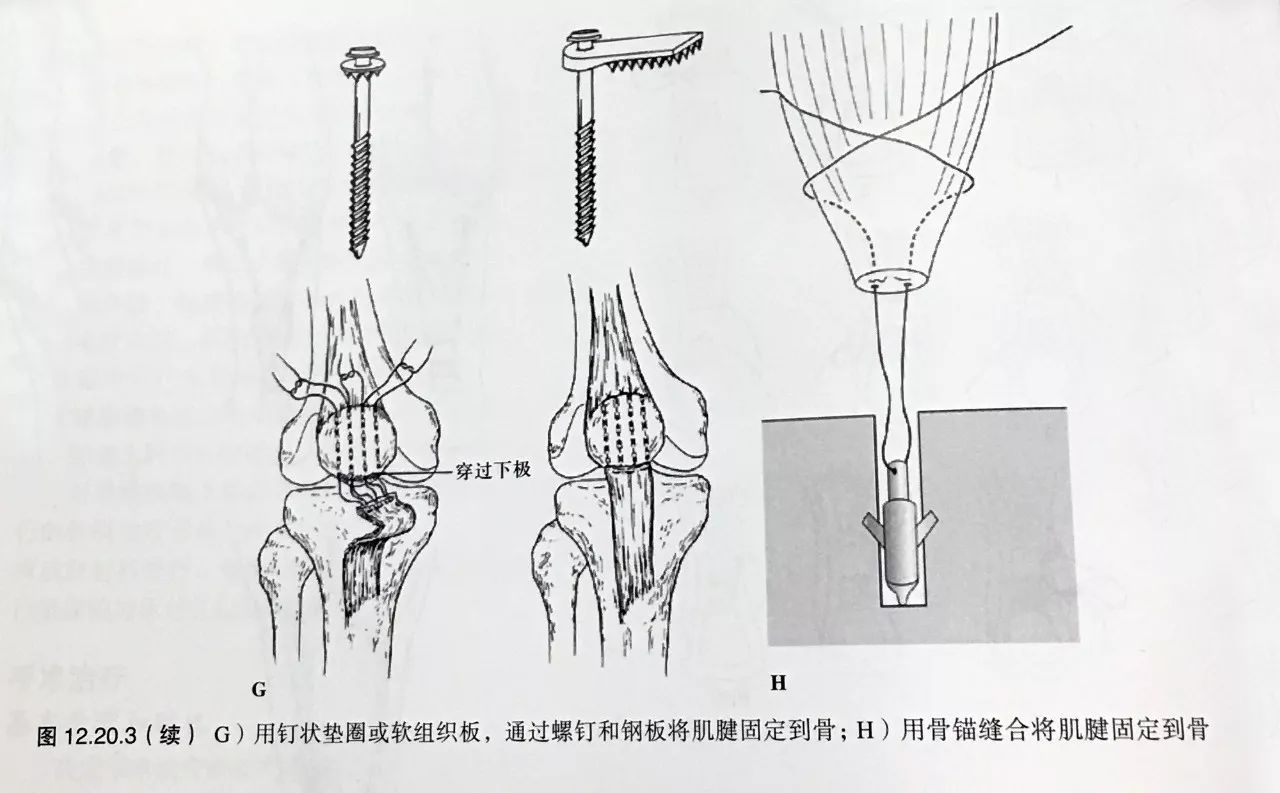 后者可以通过钻孔后只用特殊设计的锚定缝线进行缝合(图1f和图2h)