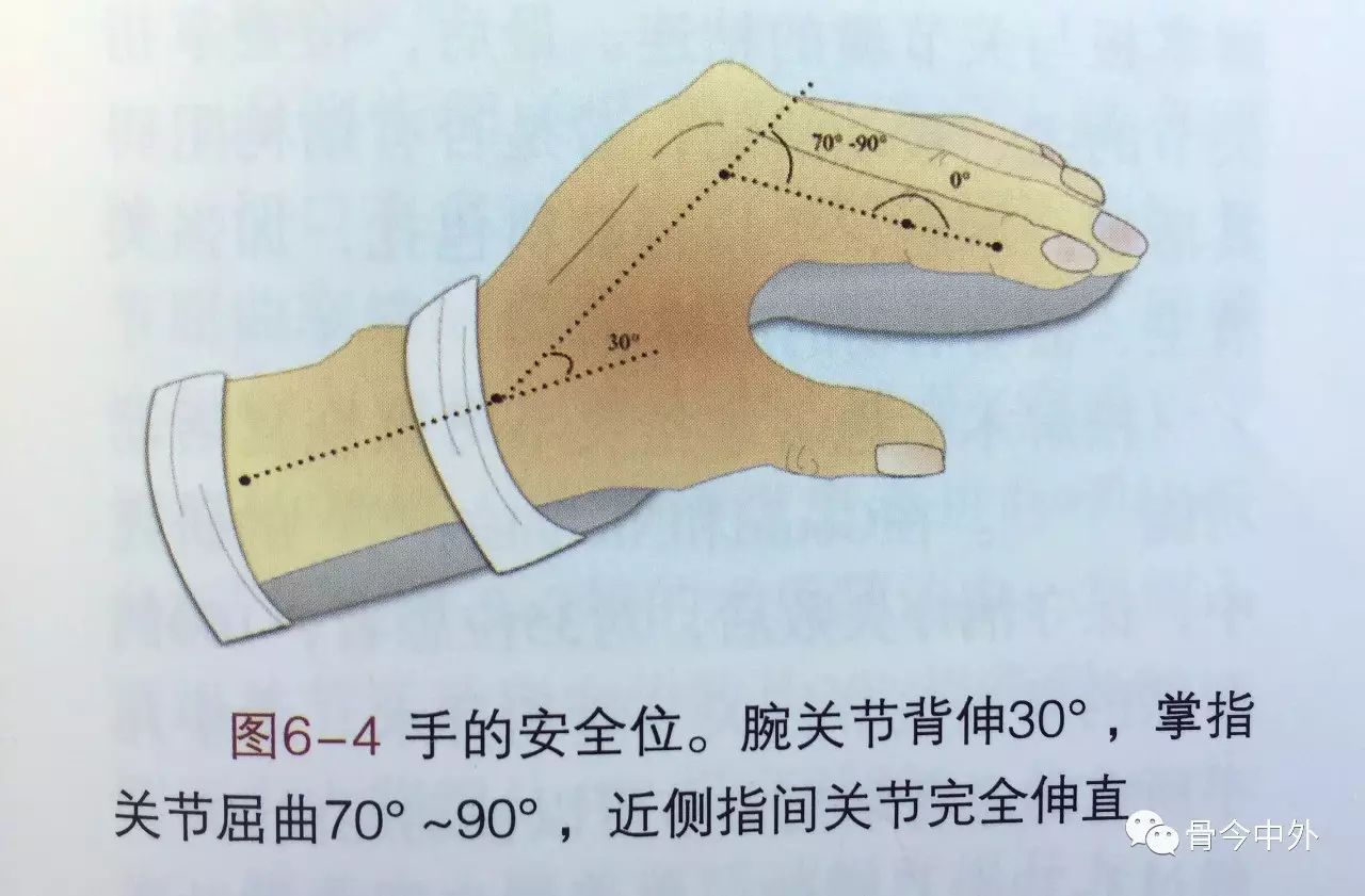 图6―4,指间关节完全伸直,这样掌指关节的侧副韧带可以拉至最长,近指