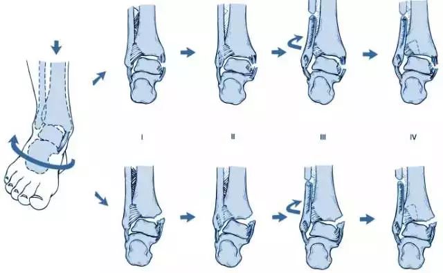 后胫腓韧带撕裂或胫骨后外侧撕脱骨折.