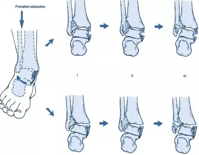 踝关节骨折lauge-hansen分型 | 基础回顾