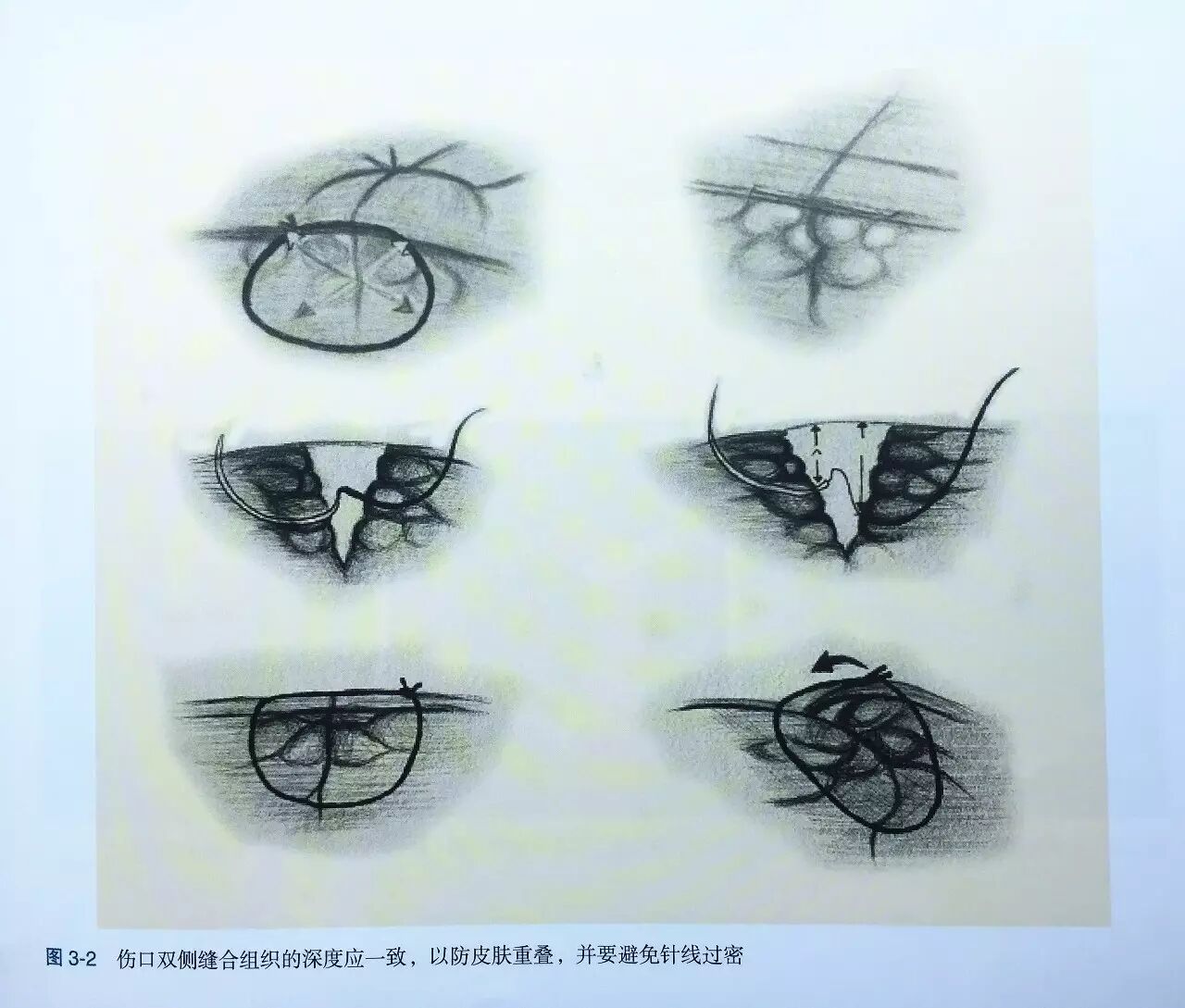 缝伤口怎么打结技巧丨术后伤口难愈合？伤口缝合有绝招_https://www.jmylbn.com_新闻资讯_第3张