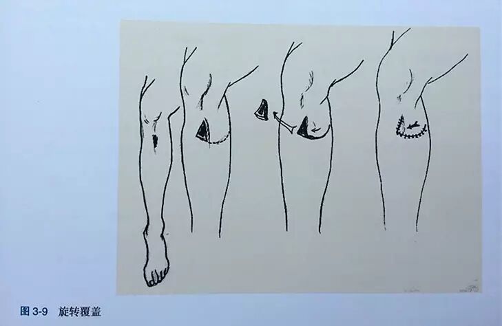 缝伤口怎么打结技巧丨术后伤口难愈合？伤口缝合有绝招_https://www.jmylbn.com_新闻资讯_第10张