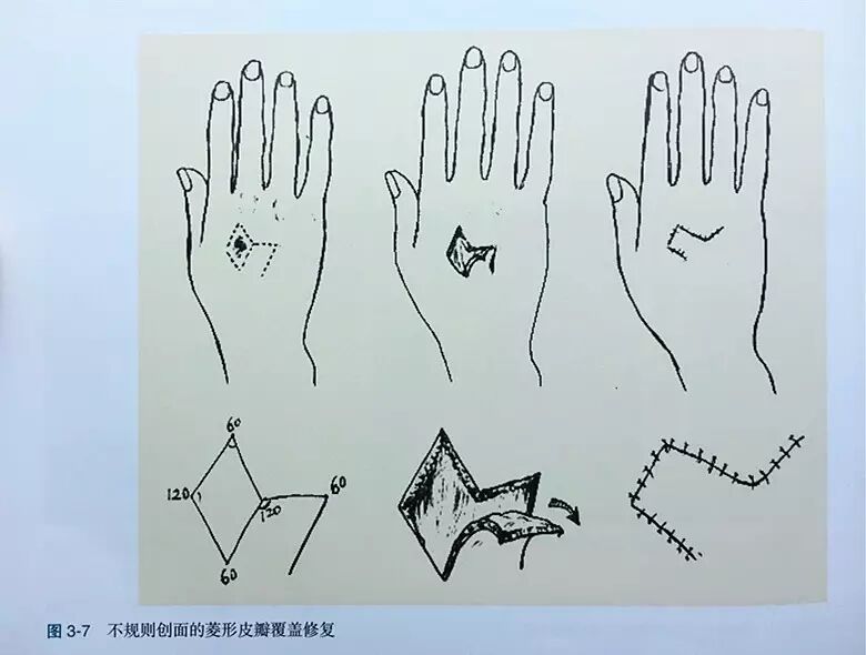 缝伤口怎么打结技巧丨术后伤口难愈合？伤口缝合有绝招_https://www.jmylbn.com_新闻资讯_第8张