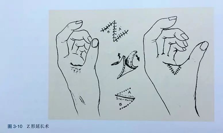 缝伤口怎么打结技巧丨术后伤口难愈合？伤口缝合有绝招_https://www.jmylbn.com_新闻资讯_第11张