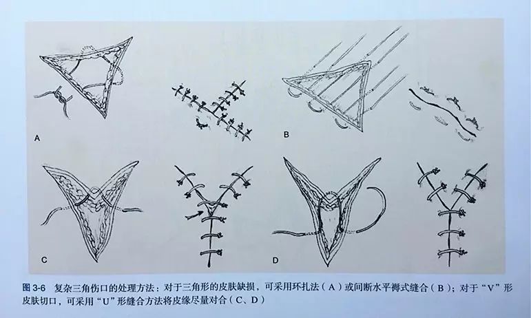 术后伤口难愈合?伤口缝合有绝招