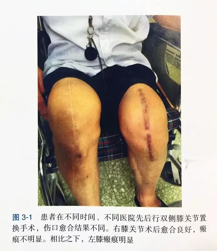 缝伤口怎么打结技巧丨术后伤口难愈合？伤口缝合有绝招_https://www.jmylbn.com_新闻资讯_第2张