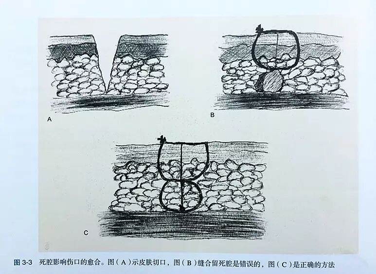 缝伤口怎么打结技巧丨术后伤口难愈合？伤口缝合有绝招_https://www.jmylbn.com_新闻资讯_第4张