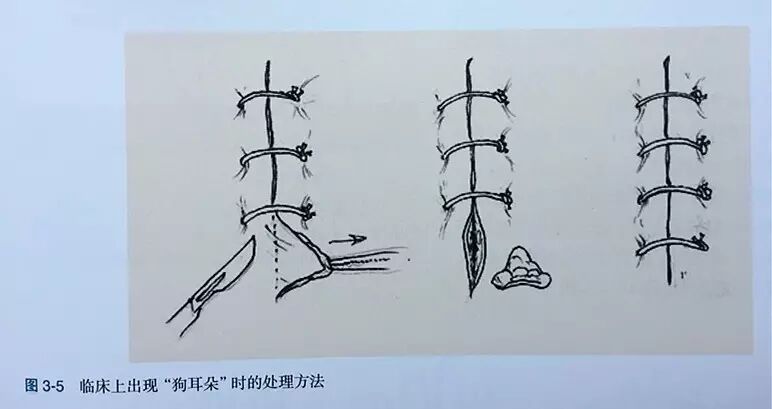 缝伤口怎么打结技巧丨术后伤口难愈合？伤口缝合有绝招_https://www.jmylbn.com_新闻资讯_第6张