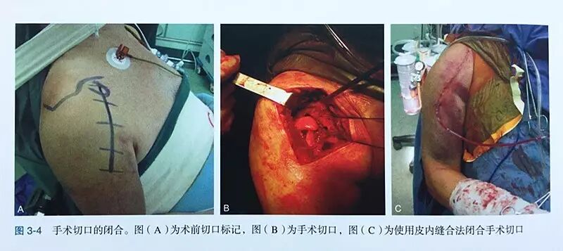 缝伤口怎么打结技巧丨术后伤口难愈合？伤口缝合有绝招_https://www.jmylbn.com_新闻资讯_第5张