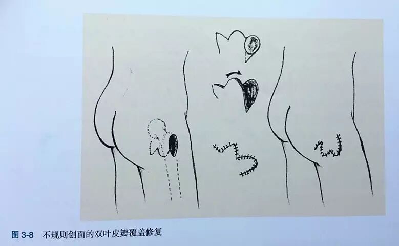 缝伤口怎么打结技巧丨术后伤口难愈合？伤口缝合有绝招_https://www.jmylbn.com_新闻资讯_第9张