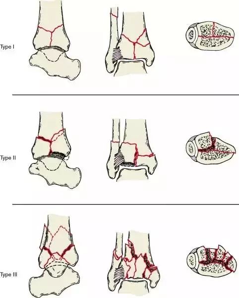 pilon骨折的损伤机制及分型 | 骨科基础