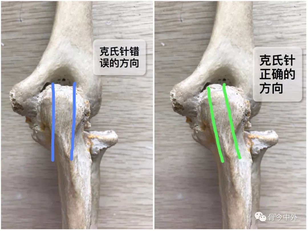 怎样才能做好尺骨鹰嘴骨折的张力带固定?