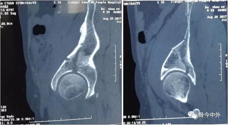 专题教程:骨盆髋臼骨折前方手术入路--stoppa及其改良