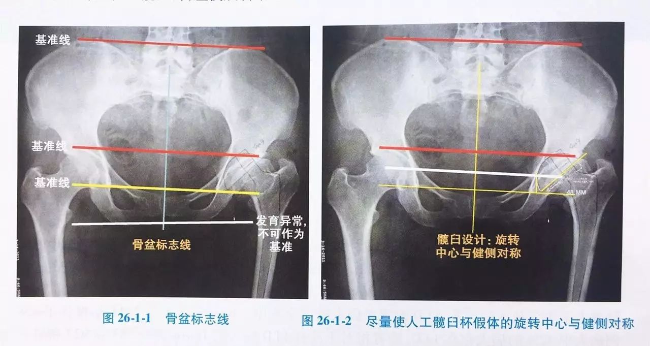 术中双下肢不等长 影响的不仅仅是病人的步态 自由微信 Freewechat