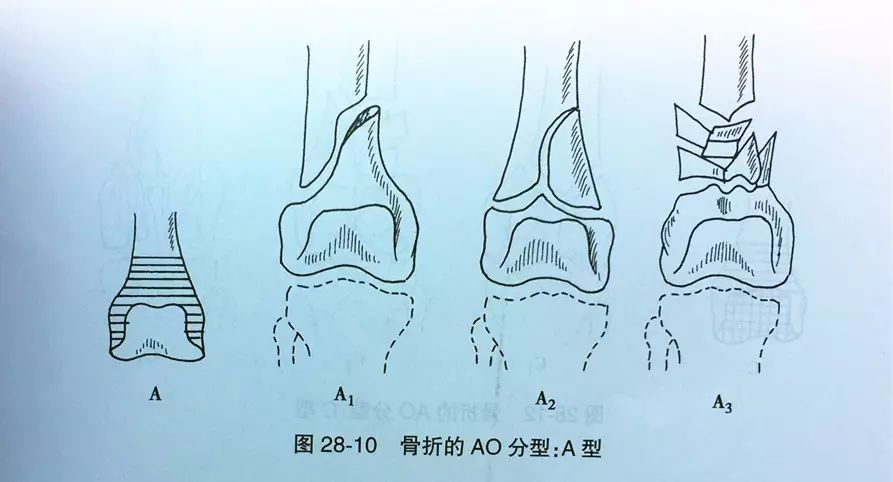 a2 型 干骺端楔形骨折,包括: (1)完整楔形; (2)外侧骨块; (3)内侧骨